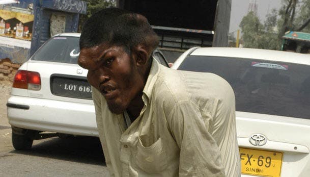 Hele hans hoved er frygtelig deformt, og det samme gør sig gældende med hans ryg