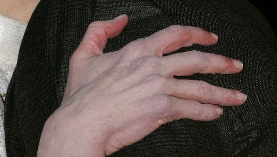 Her ses det tydeligt, at huden på hånden er bleget